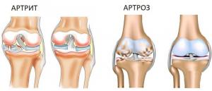 Что способствует возникновению артрозных заболеваний